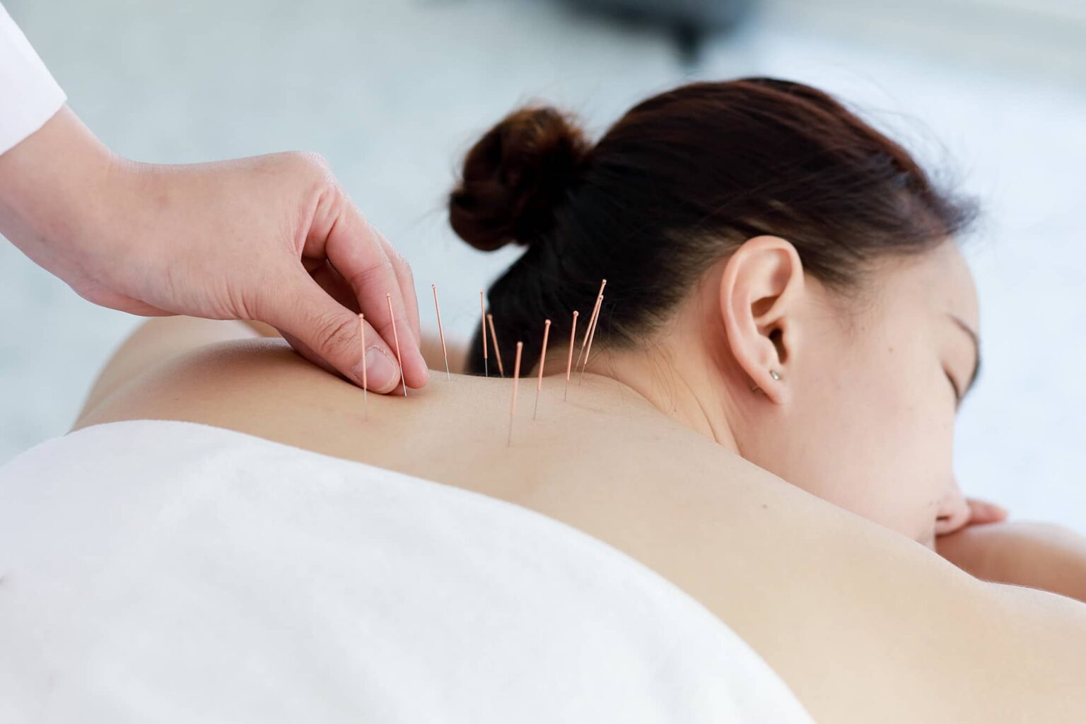 Acupuncture therapy